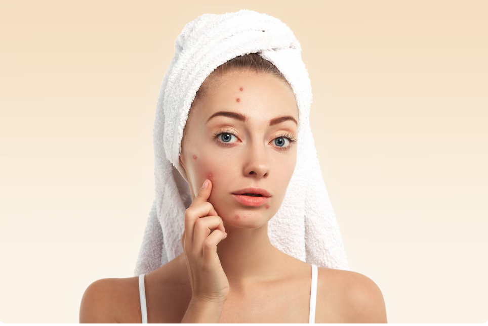 10 tips para mawala ang pimples