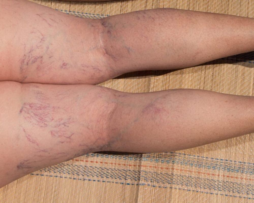 Varicose and Spider Veins